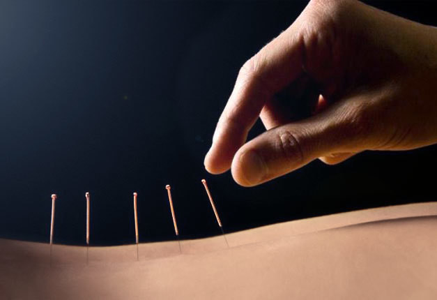 Acupuncture
